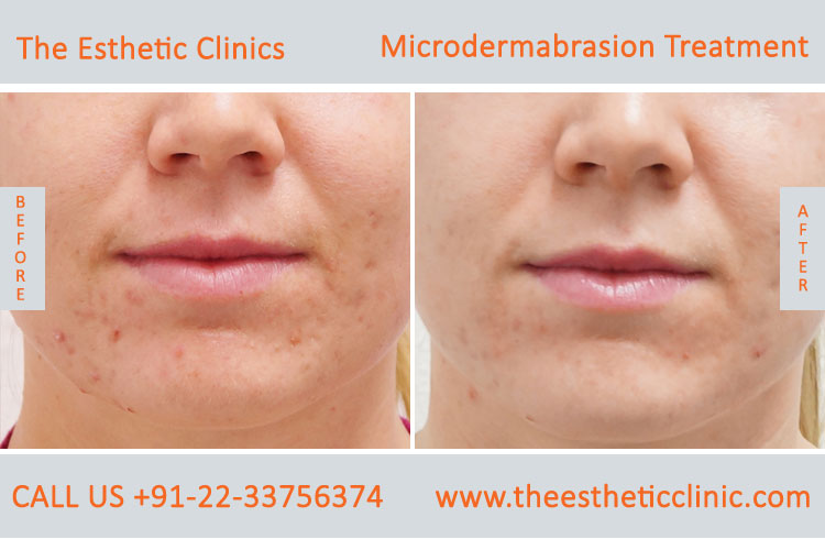 Microdermabrasion Dermabrasion Treatment before after photos in mumbai india (4)